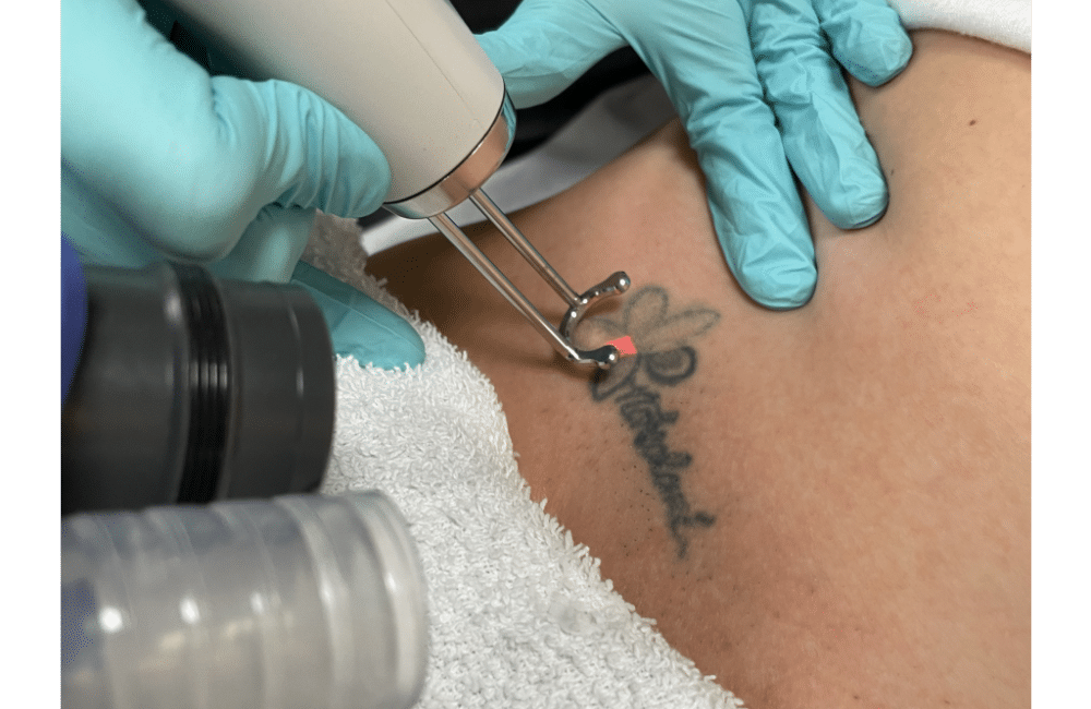 Tattooing and Tattoo Removal | SKIN lounge Aesthetics
